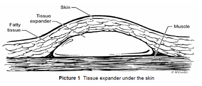 tissue expansion